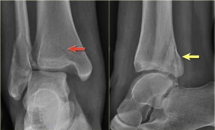 The Radiology Assistant : Ankle fracture - Weber and Lauge-Hansen