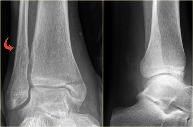 Weber C fracture - stage 3