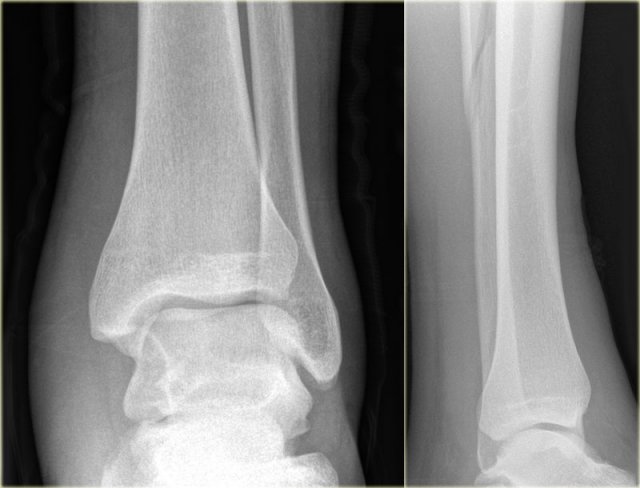 Weber C fracture - at least stage 3