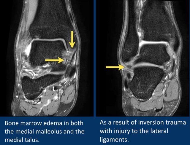 MR Imaging of Deltoid Ligament Pathologic Findings and Associated  Impingement Syndromes