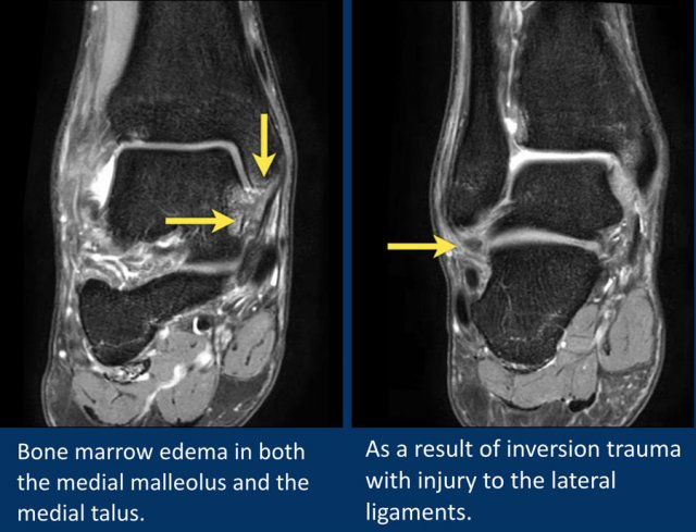 MRI Musculo-Skeletal Section: Deltoid ligament injury.