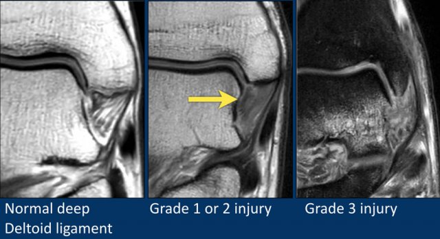 Deltoid ligament of the ankle  Radiology Reference Article