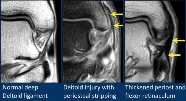 MR Imaging of Deltoid Ligament Pathologic Findings and Associated  Impingement Syndromes