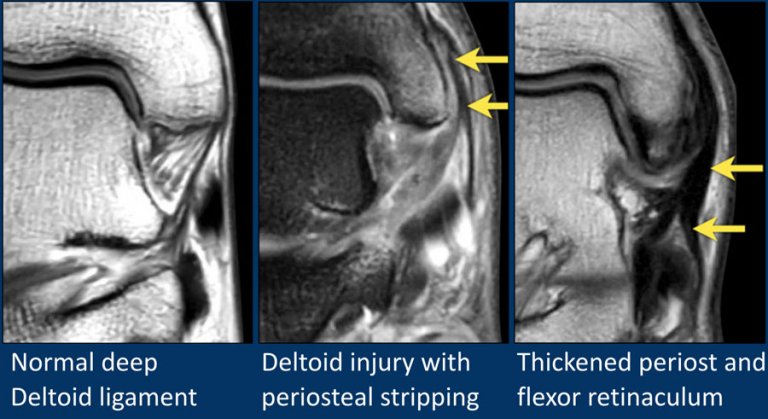 The Radiology Assistant : MRI examination of the ankle