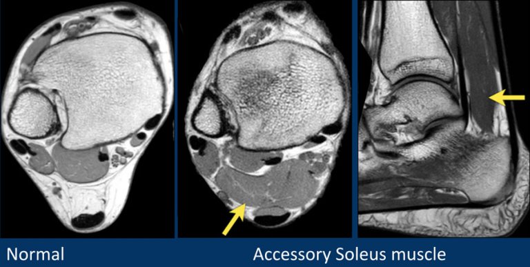 The Radiology Assistant : MRI examination of the ankle