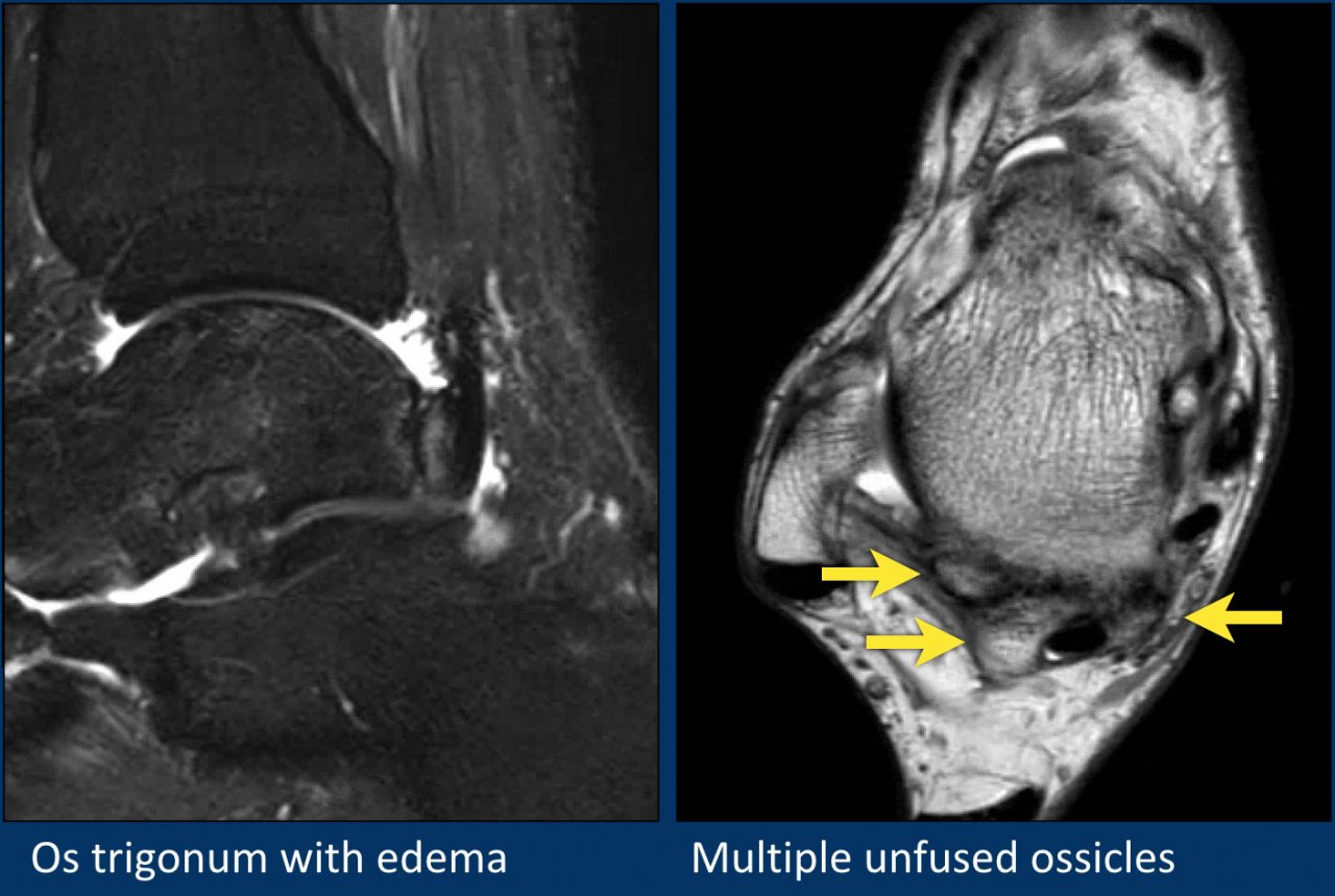 The Radiology Assistant : MRI examination of the ankle