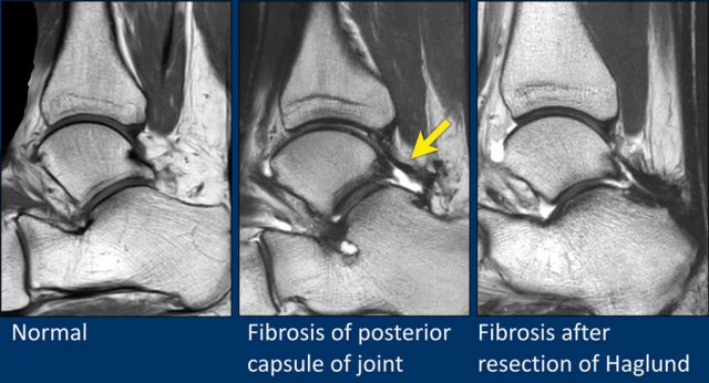 abnormal-mri-of-foot-tendon