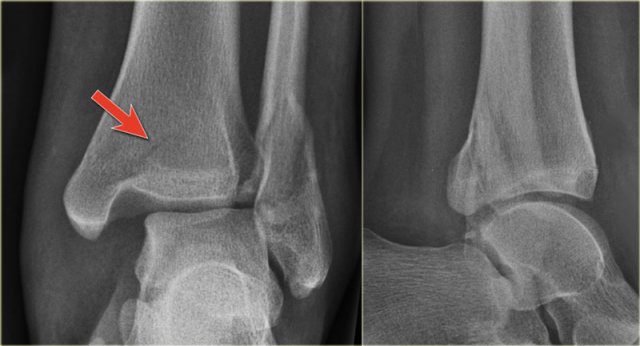 Linear lucency indicating a fracture of the posterior malleolus