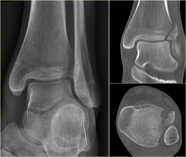 Ankle Fracture - Welk Security & Trust