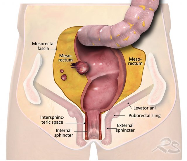 The illustration shows the mesorectum and the mesorectal fascia, which is the plane for TME resection and the relation of the rectum to the anal sphincter and pelvic floor.