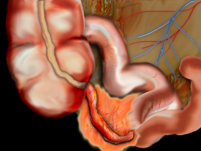 Appendicitis with periappendical fat infiltration.Click on the image to enlarge