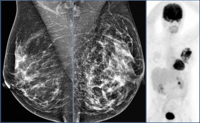 Labeled normal mammograms, Radiology Case