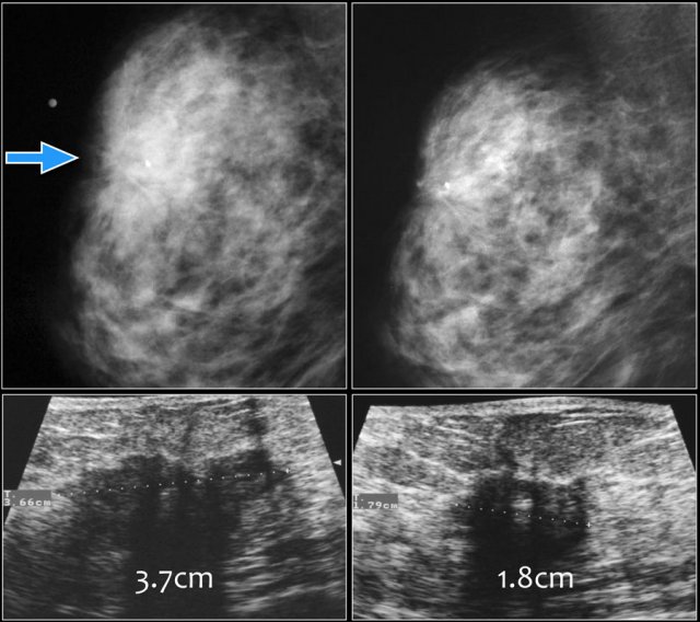 On the left BI-RADS 5 lesion. On the right after neo-adjuvant chemotherapy BI-RADS 6.