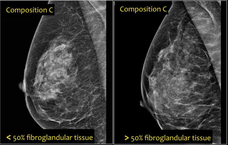 The Radiology Assistant : Bi-RADS for Mammography and Ultrasound 2013