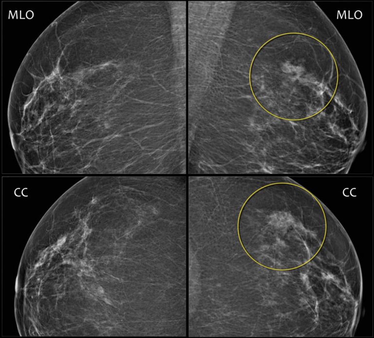 The Radiology Assistant : Bi-RADS For Mammography And Ultrasound 2013