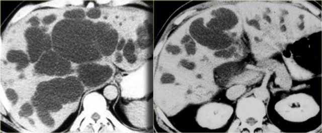 Saccular bile duct dilatation in Caroli disease