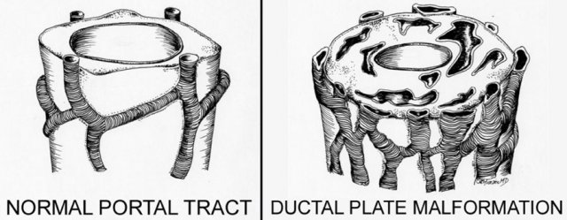Abnormal development of the ductal plate(Illustration by Aletta Frazier)