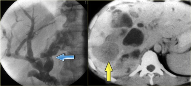 LEFT: Infiltrating cholangiocarcinoma with stricture in a patient with Caroli disease RIGHT:  Intraductal cholangiocarcinoma