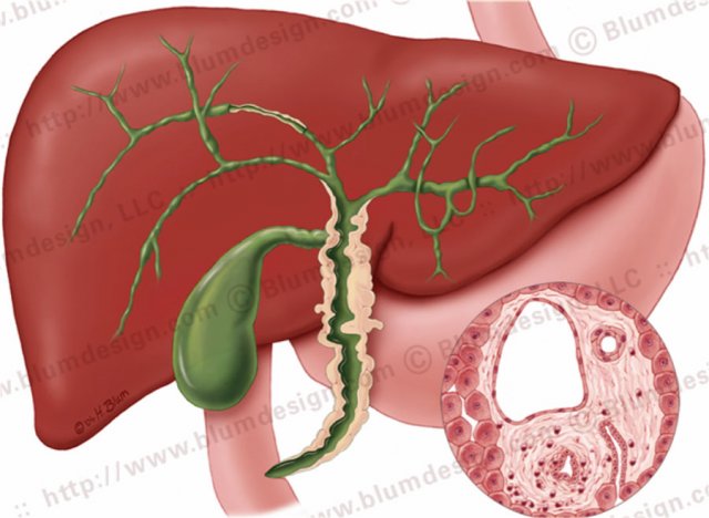 Primary sclerosing cholangitis with strictures both in the intra- and extrahepatic bile ducts. Illustration by Heike Blum