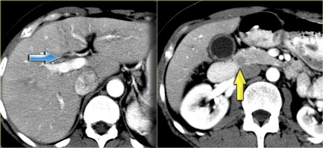 PSC with thickening of the wall of the bile duct (arrow)