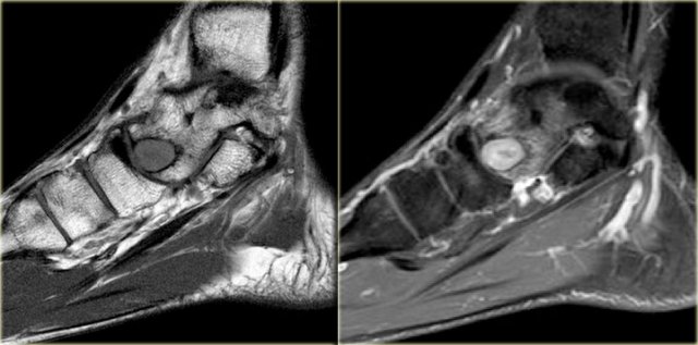 Chondroblastoma. Sagittal T1-weighted image (left) and  sagittal T1-weighted image with fatsat after Gd-DTPA (right). 