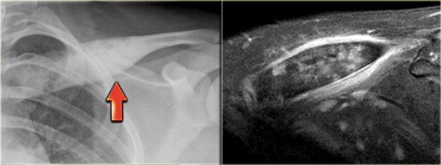 Sclerotic EG in clavicula with surrounding edema.