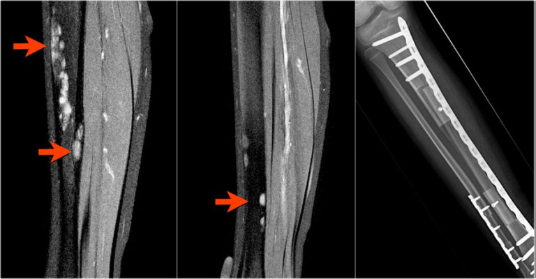 The Radiology Assistant : Bone tumor A-G