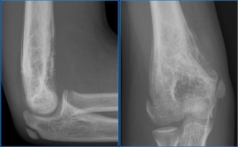 The Radiology Assistant : Bone Tumor A-g