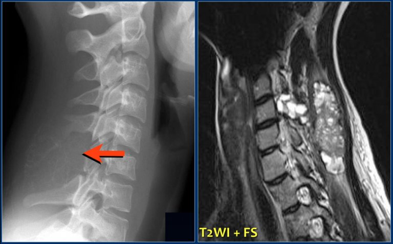 The Radiology Assistant : Bone tumor A-G