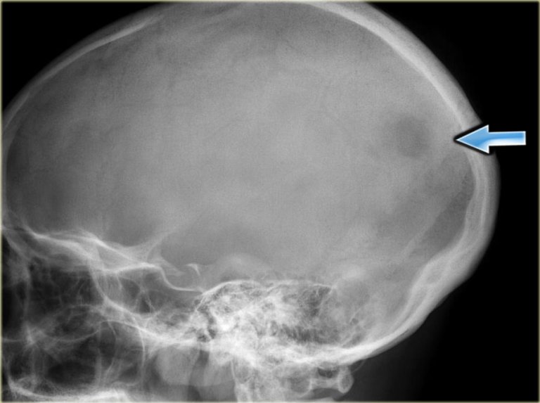 The Radiology Assistant : Osteolytic - Ill Defined Bone Tumors