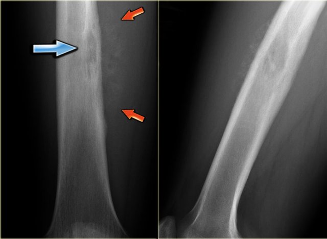 Ewing's sarcoma in diaphysis of the femur. Notice ill-defined zone of transition (blue arrow) and aggressive type of periosteal reaction (red arrows)