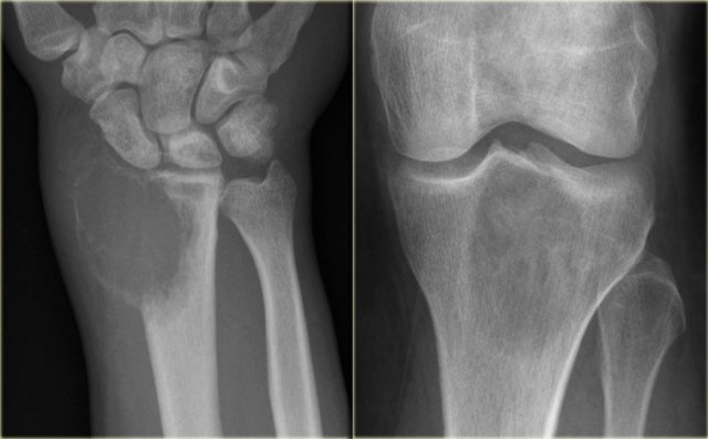 GCT of the radius with ill-defined margins on the left and a GCT in the tibia with well-defined margins