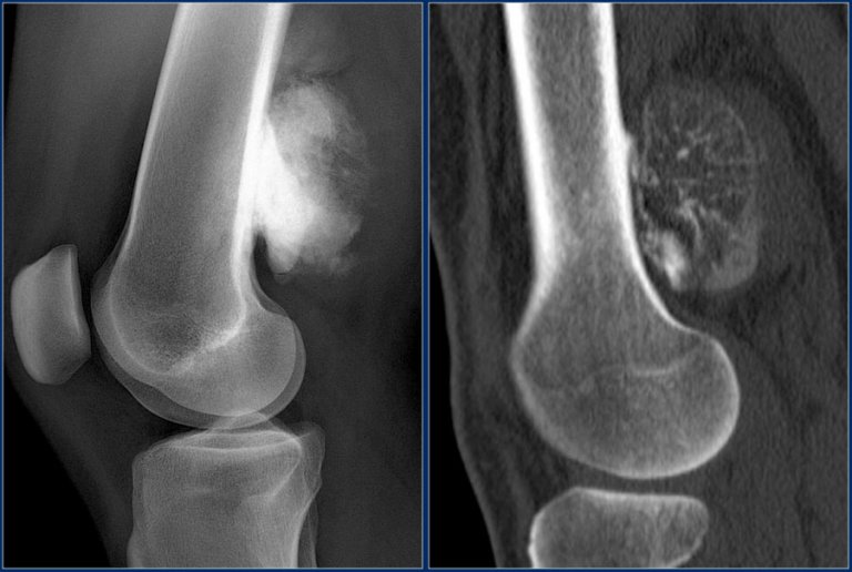 The Radiology Assistant : Bone tumor P-Z