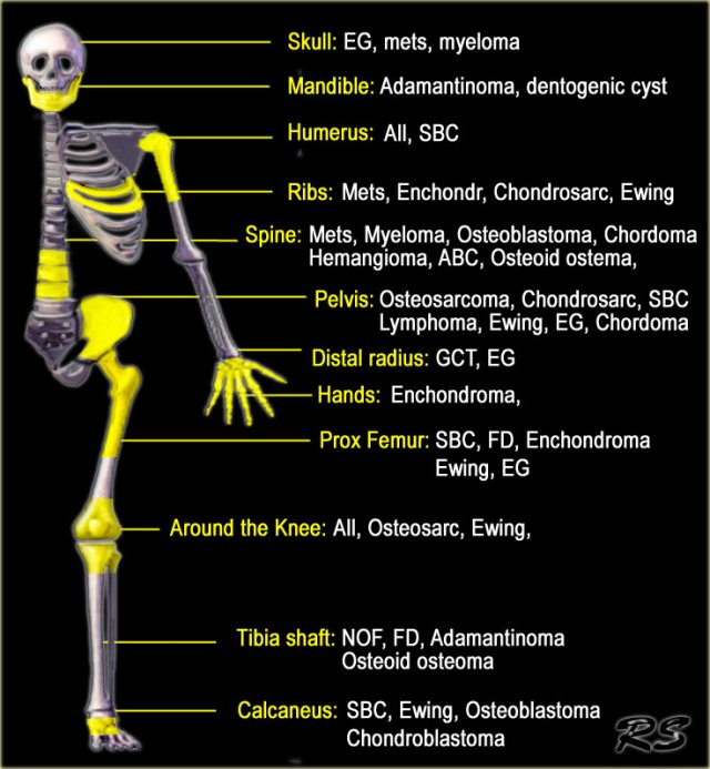 Bone cancer on the skull: Symptoms and more