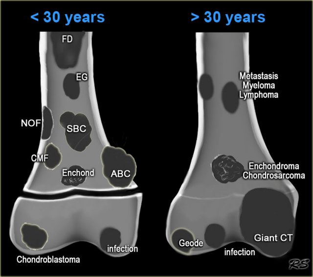 Enchondroma Mri