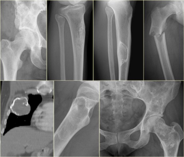 Fibrous dysplasia: various presentations with or without sclerotic margin, with groundglass appearance, with calcifications or ossifications