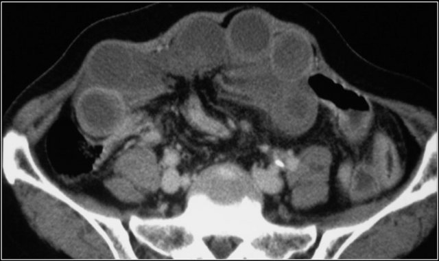 Gray enhancement pattern in a patient with closed loop obstruction.