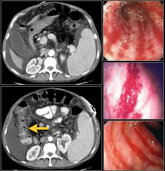 Right -sided colitis in a patient with cirrhosis and portal hypertension. The endoscopic images are of different patient with right-sided colitis.