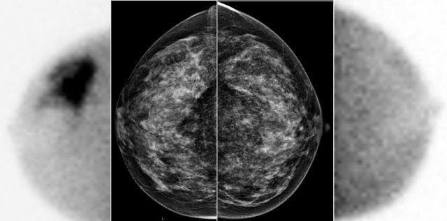 A large tumor in the  right breast is easily detected with  BSGI, while hardly visible on the mammogram.