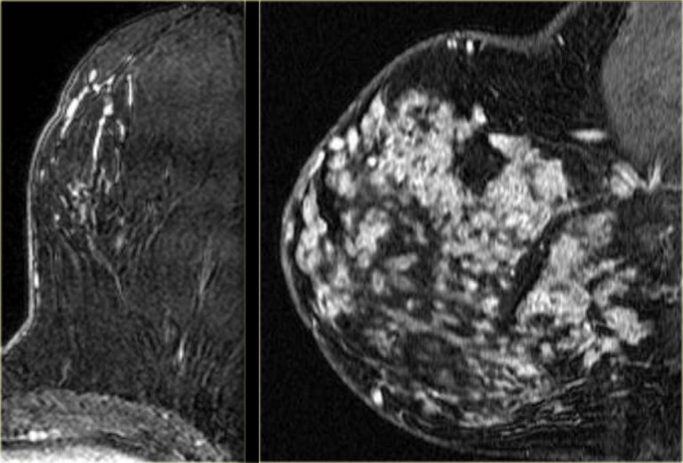 the-radiology-assistant-mri-of-the-breast