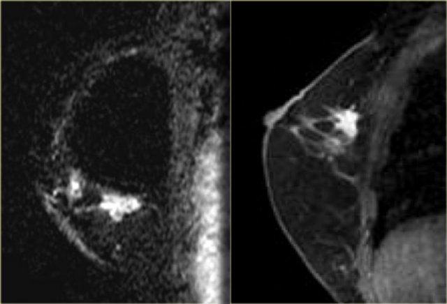 Two cases of invasive lobular carcinoma