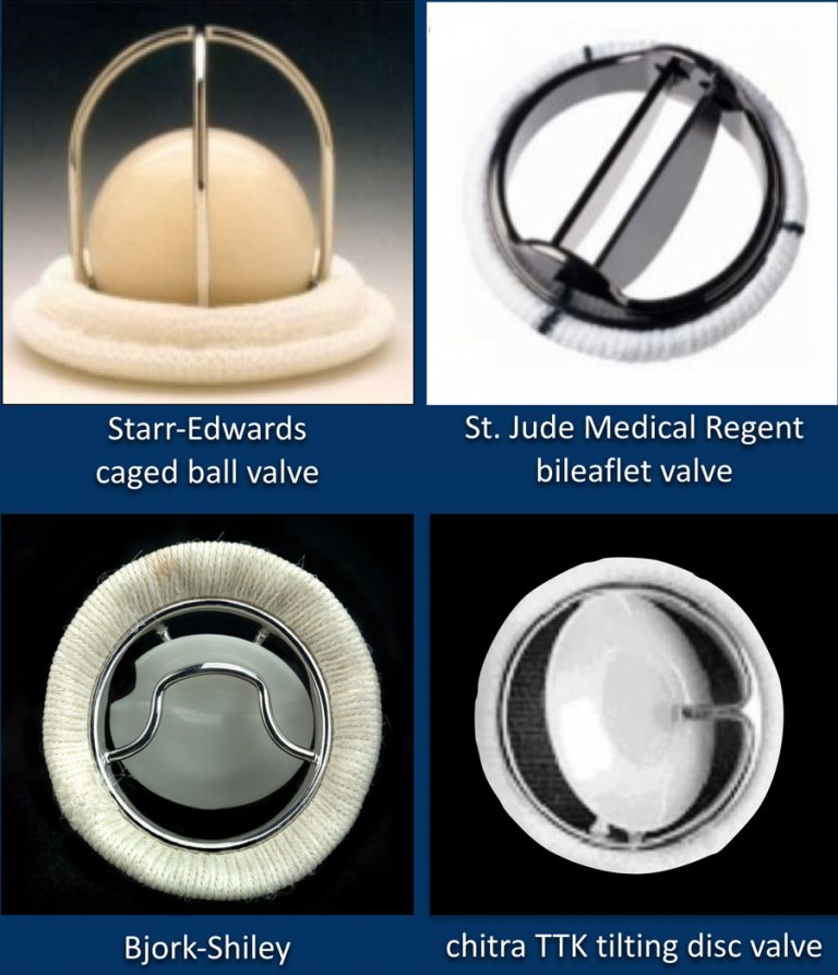 The Radiology Assistant : Cardiovascular devices