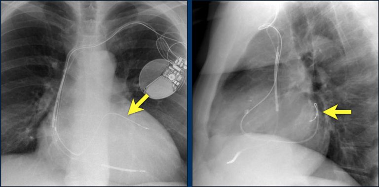 The Radiology Assistant : Cardiovascular devices