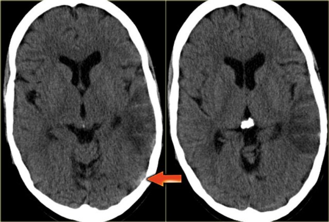 Venous infarct in Labbe territory