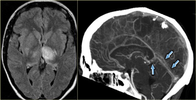 superior sagittal sinus thrombosis