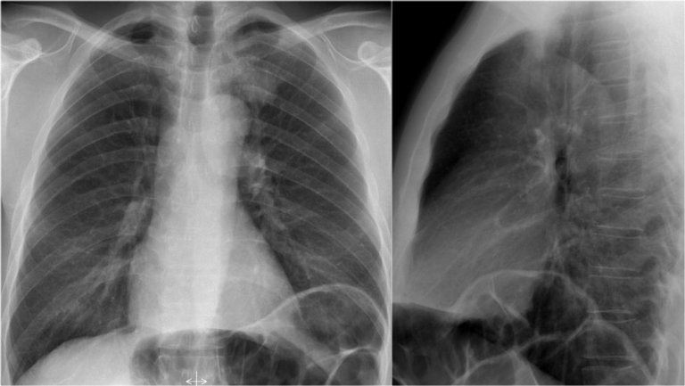 The Radiology Assistant : Chest X-Ray - Basic Interpretation