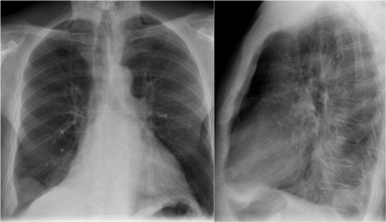 The Radiology Assistant : Chest X-Ray - Basic Interpretation