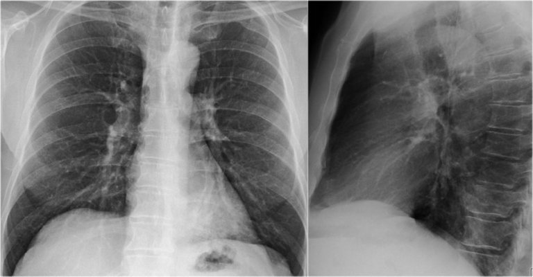 The Radiology Assistant : Chest X-Ray - Basic Interpretation