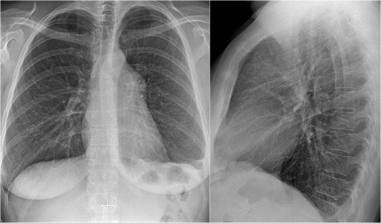 The Radiology Assistant : Chest X-Ray - Basic Interpretation