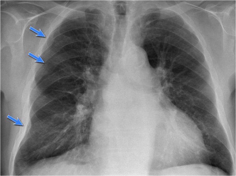 The Radiology Assistant : Chest X-Ray - Basic Interpretation